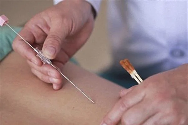 做注射去疤价格要多少