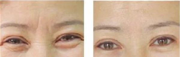 激光除眉间纹维持时间是多久？