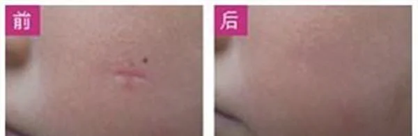 微晶磨削点痣手术安全吗？
