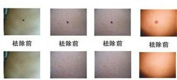 微晶磨削点痣手术效果好不好？