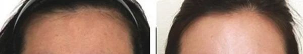 做去抬头纹失败修复价格要多少