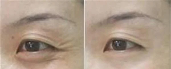 玻尿酸去鱼尾纹要多少钱？