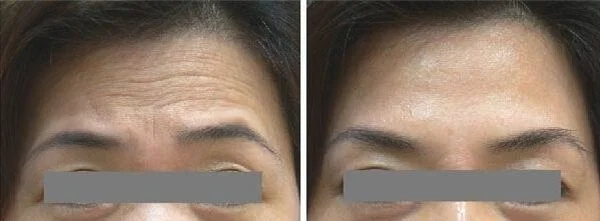 做内窥镜除皱去抬头纹多少钱