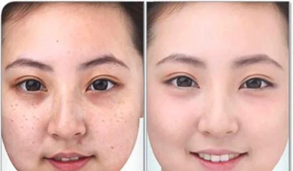 做祛斑手术多少钱?