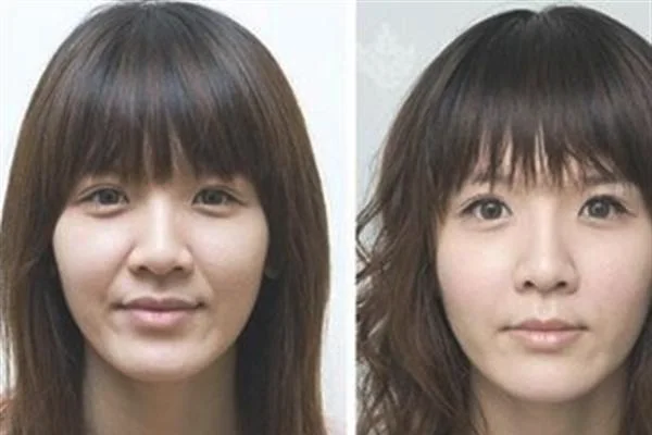做光子去法令纹费用大概需要多少