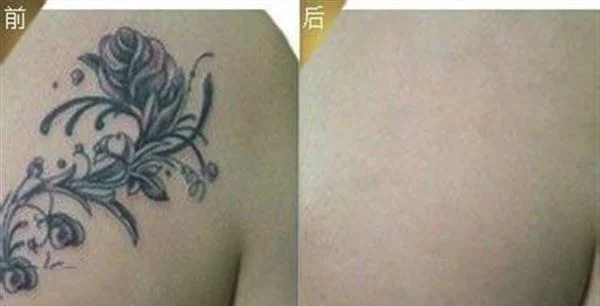 做电灼去纹身价格贵不贵