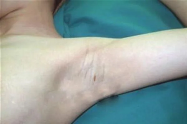 去狐臭手术术后护理？