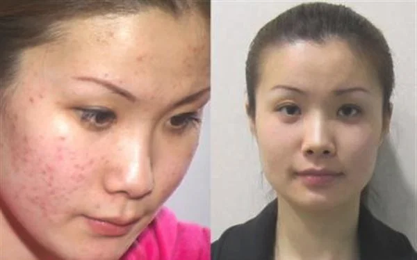 做E光去痘印价格贵不贵