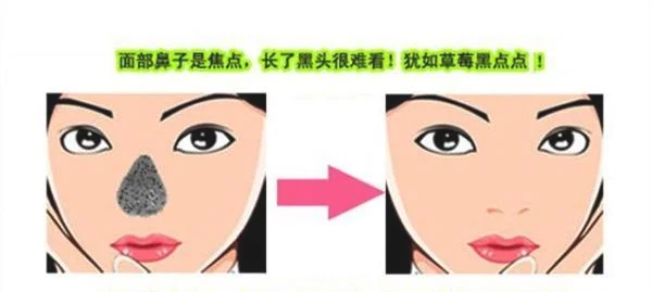 做去黑头治疗效果怎么样？效果保持时间多久？