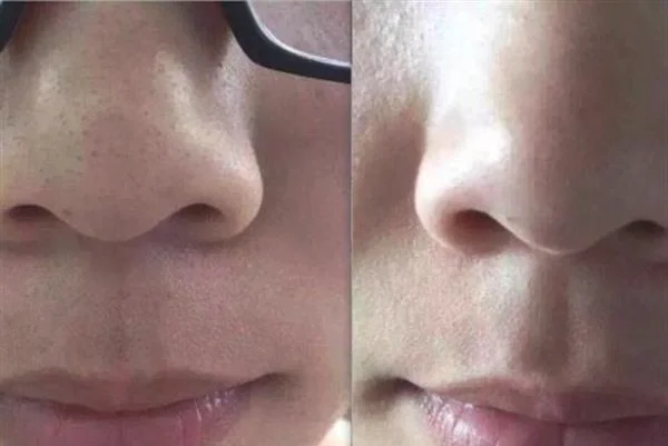 做去黑头手术多少钱？