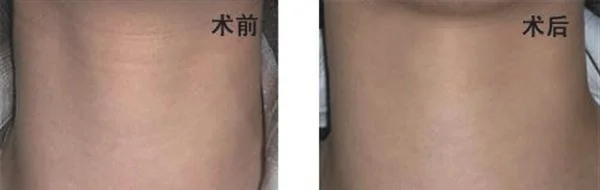 做激光除颈纹多少钱