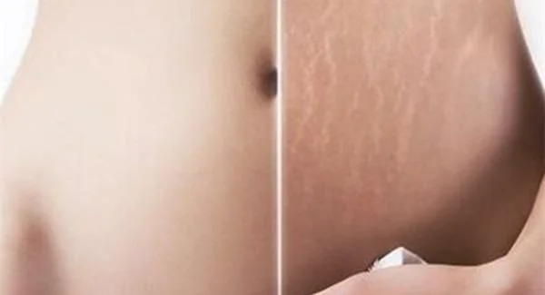 做去妊娠纹手术注意事项是什么？