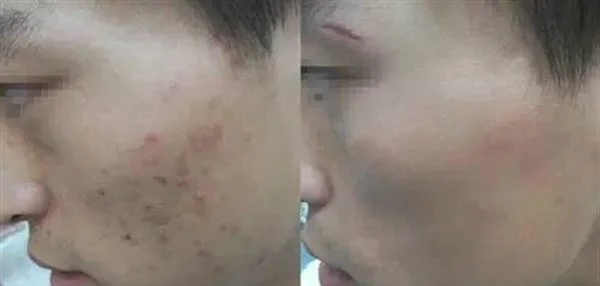 做射频微针去痘疤手术多少钱？