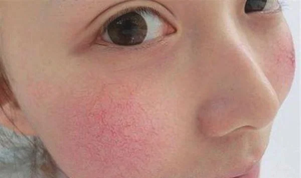 红血丝怎么消除