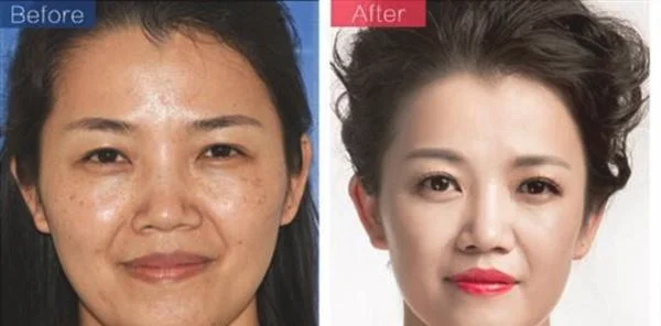 做光子祛斑多少钱