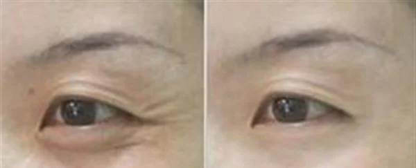 做去鱼尾纹失败修复费用多少钱