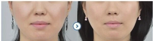 做胶原蛋白去法令纹价格