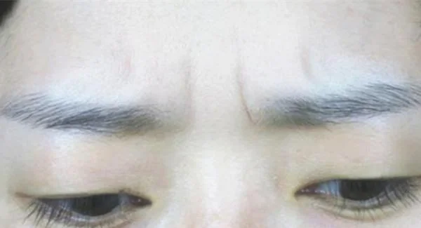 做自体脂肪去眉间纹价格是多少