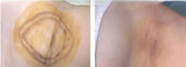 做激光去腋臭价格贵不贵