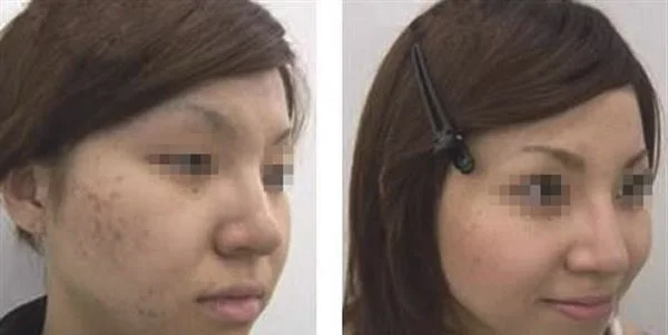 做去粉刺治疗效果怎么样？效果保持时间多久？