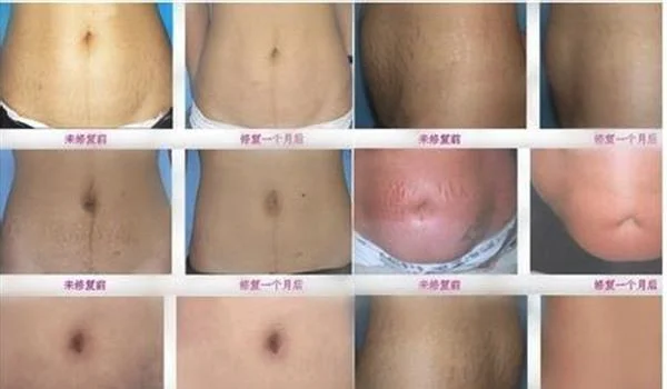 剖腹产疤痕修复多久能恢复？