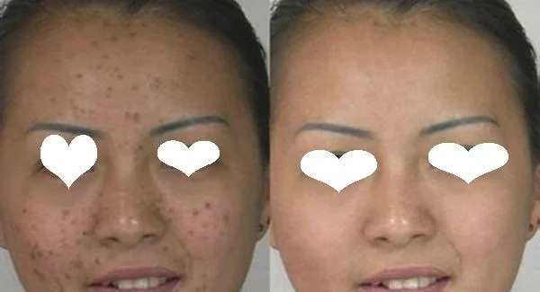 做光子去痘印价格是多少