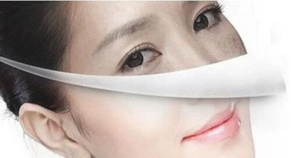 做E光去黄褐斑价格贵吗