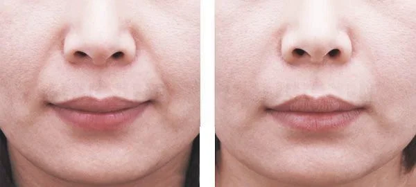 做玻尿酸去眼角细纹费用要多少