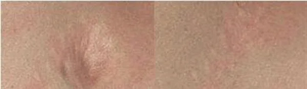 做烫伤疤痕修复治疗效果怎么样?效果保持时间多久?