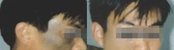 做E光治疗太田痣治疗效果怎么样?效果保持时间多久?