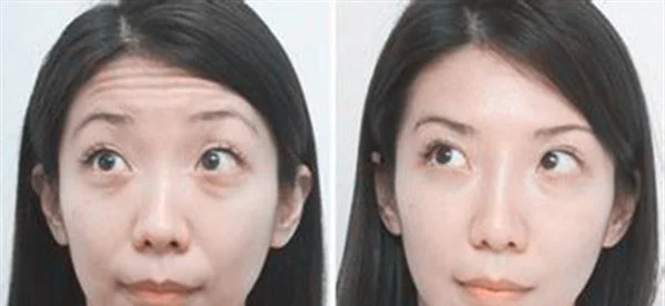 做去抬头纹失败修复费用多少钱