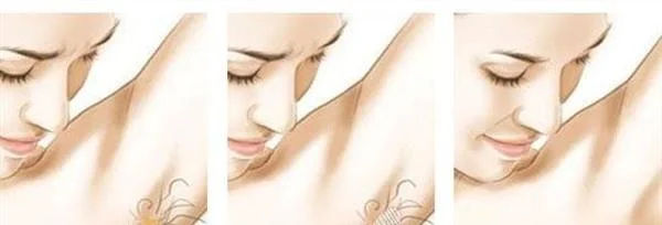 做去腋臭多少钱