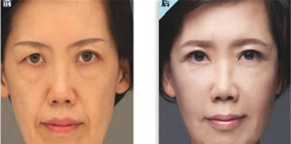 微晶磨皮去鱼尾纹效果怎么样？
