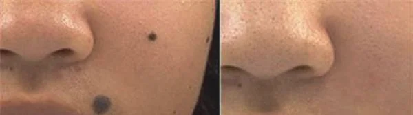 E光点痣手术注意事项是什么?