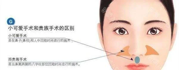 自体脂肪去法令纹手术安全吗？