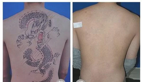 做洗纹身手术多少钱？
