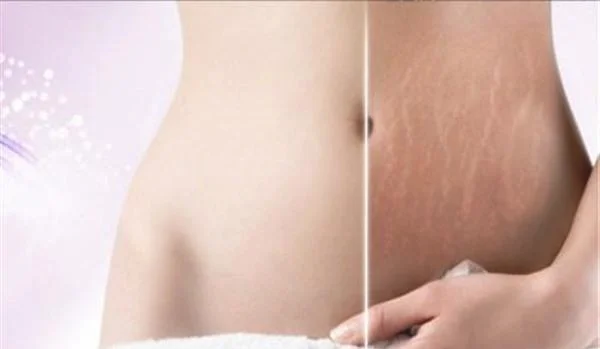 做光子去妊娠纹费用大概需要多少