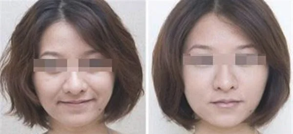 做爱贝芙去法令纹价格贵不贵