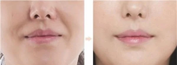 做硅胶植入去法令纹价格