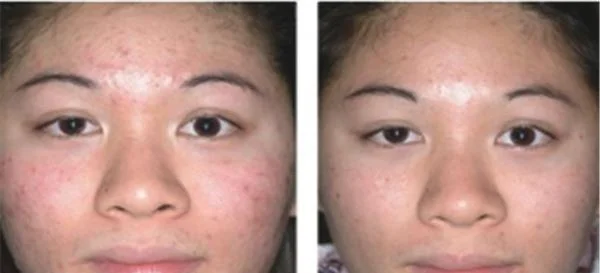 做射频微针去痘疤价格多少钱