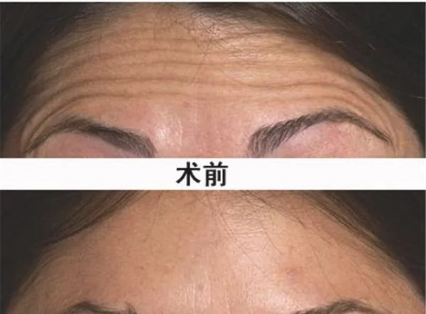 射频去抬头纹优点是什么？