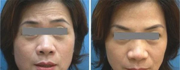 内窥镜除皱去抬头纹有副作用吗？