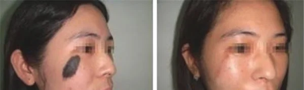 做激光点黑痣价格多少钱