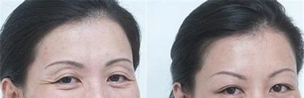 胶原蛋白去鱼尾纹要多少钱？
