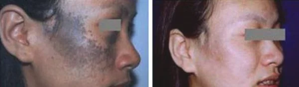 做皮肤磨削治太田痣价格贵不贵