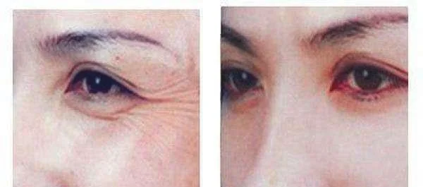 做激光去眼角细纹价格要多少