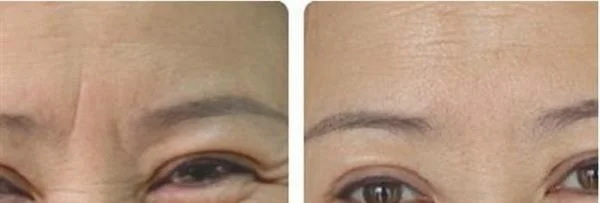 做爱贝芙去眉间纹治疗效果怎么样?效果保持时间多久?