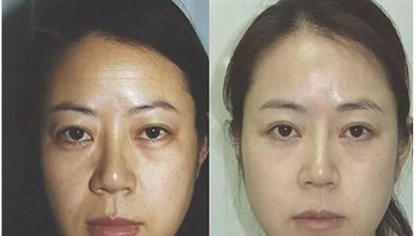 做射频去法令纹治疗效果怎么样?效果保持时间多久?