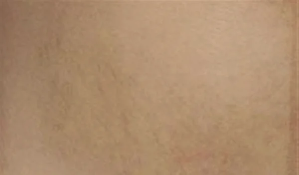 妊娠斑如何才能去除