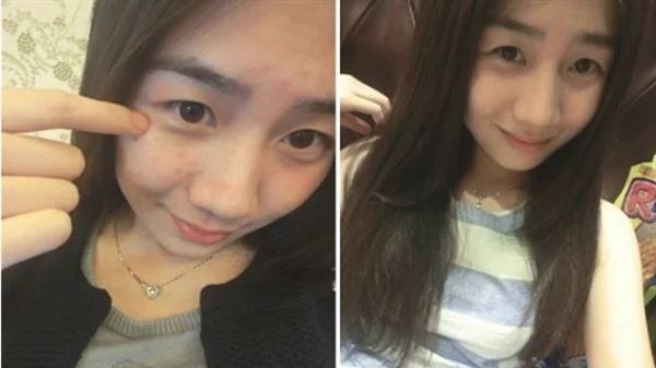 做爱贝芙去痘疤治疗效果怎么样？效果保持时间多久？